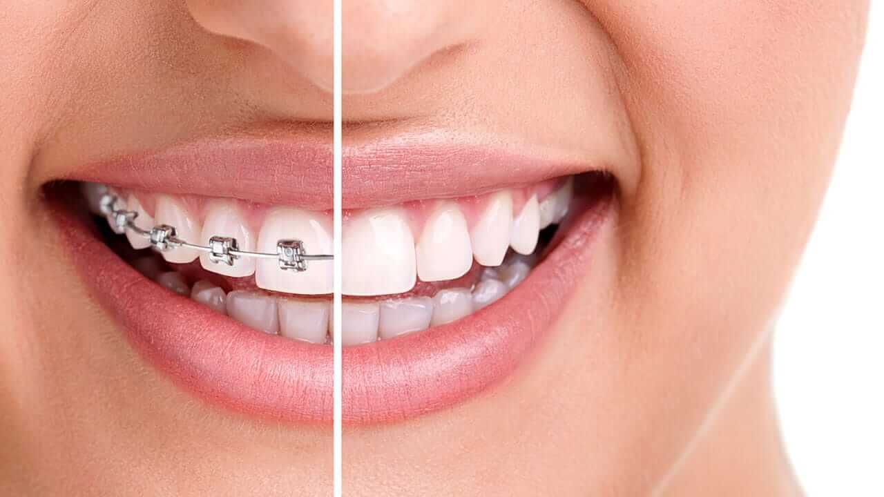 Teeth Straightening in Flint