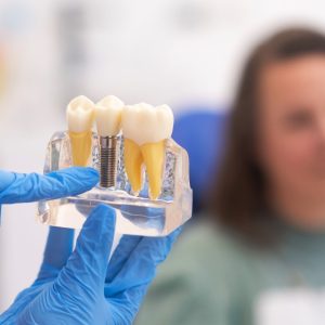 implants in flint