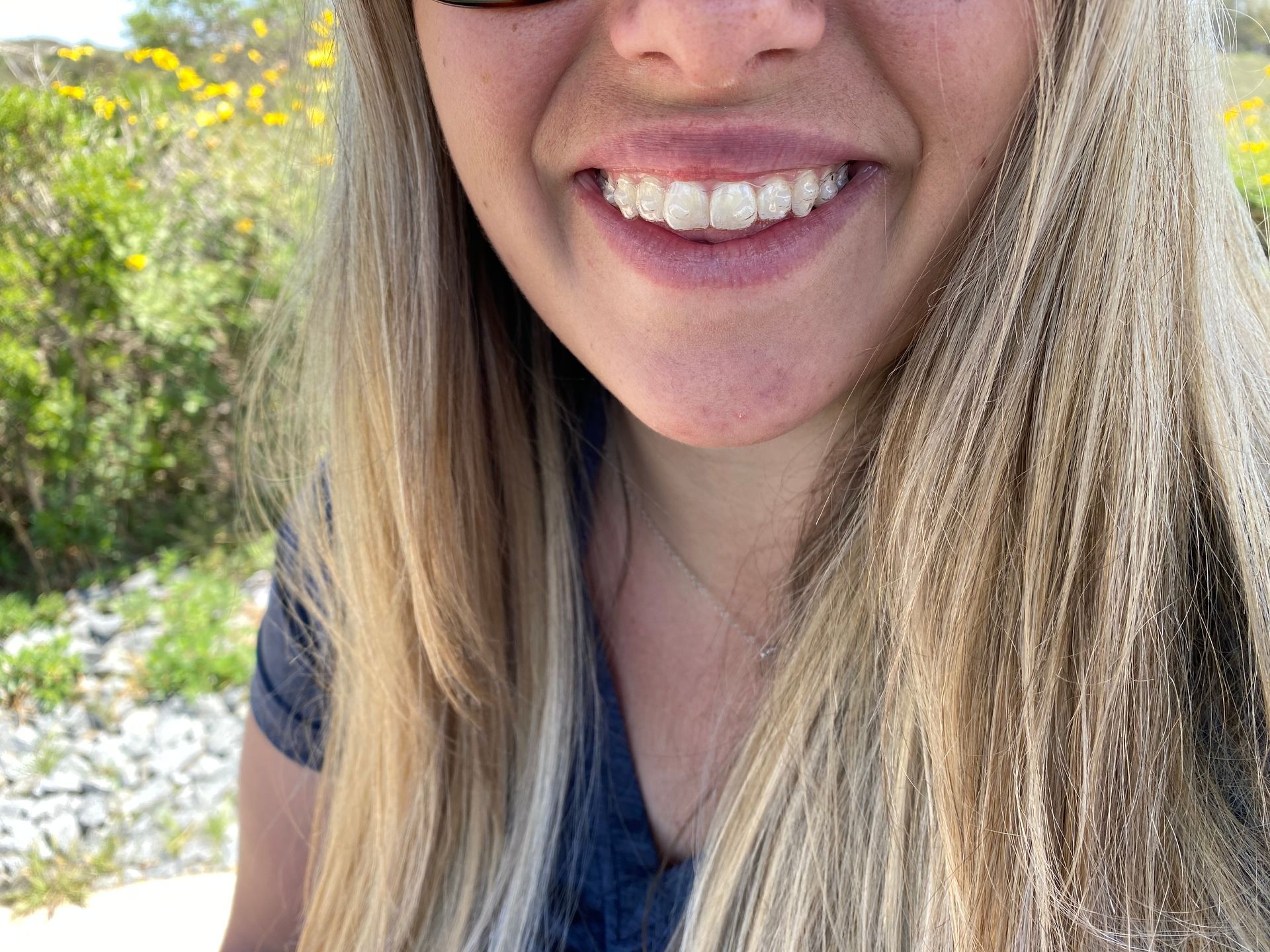 Invisalign Treatment