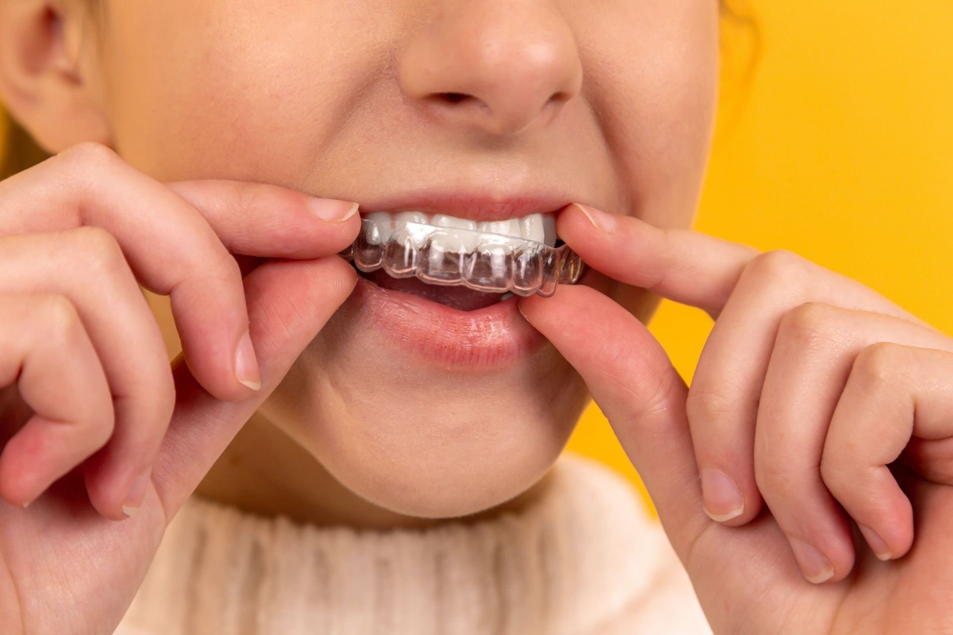 Teeth Straightening in Flint