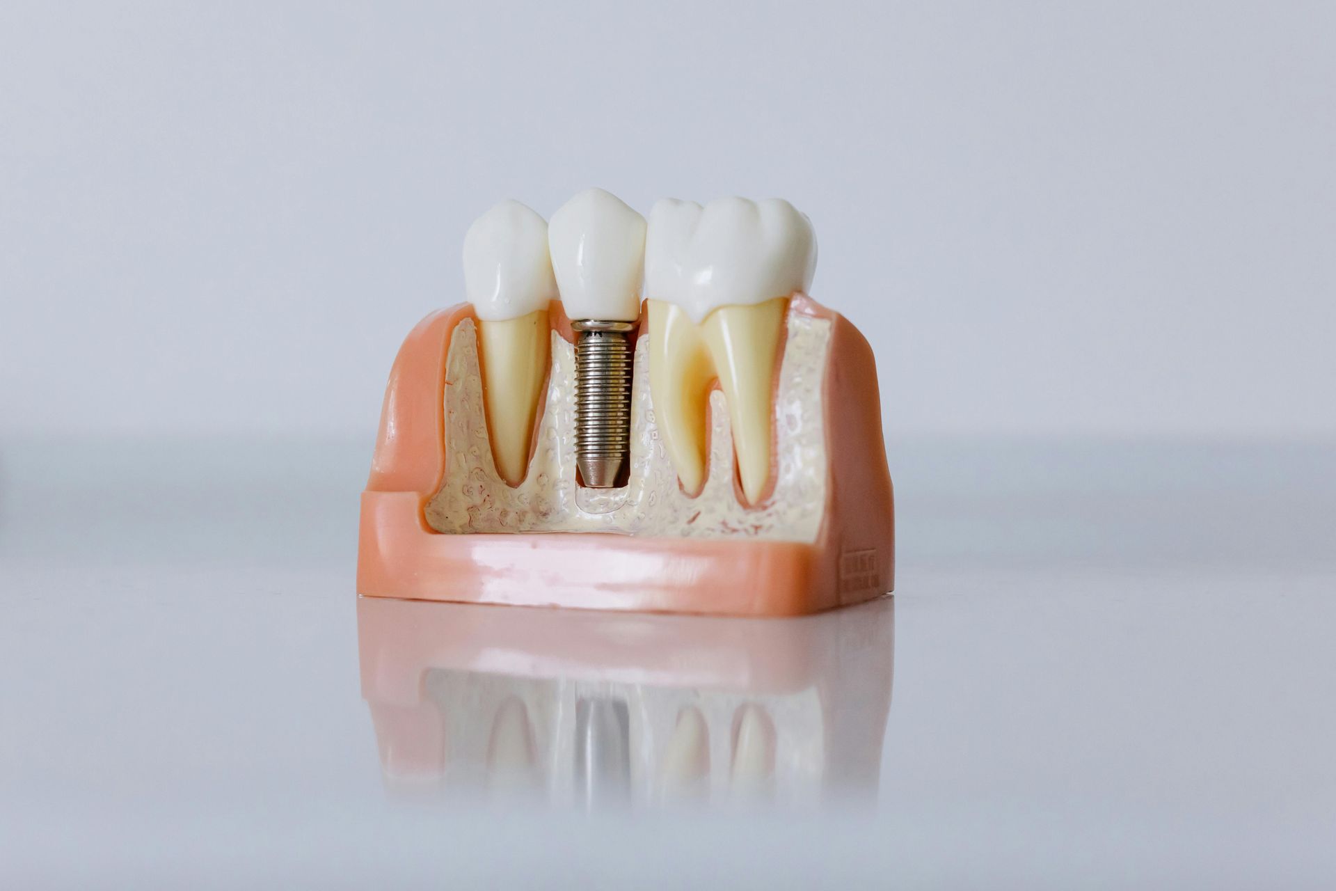 All-on-X Dental Implant