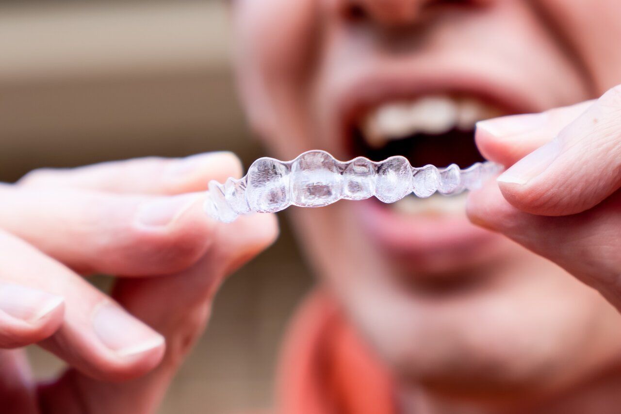 Invisalign in flint