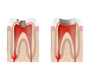 Root Canal Treatment in Flint