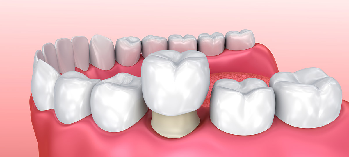 Dental Crowns in Flint