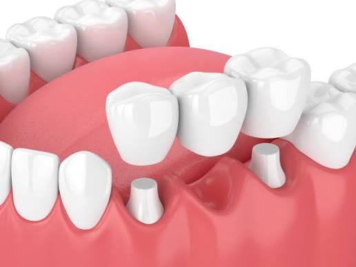 dental bridges in flint