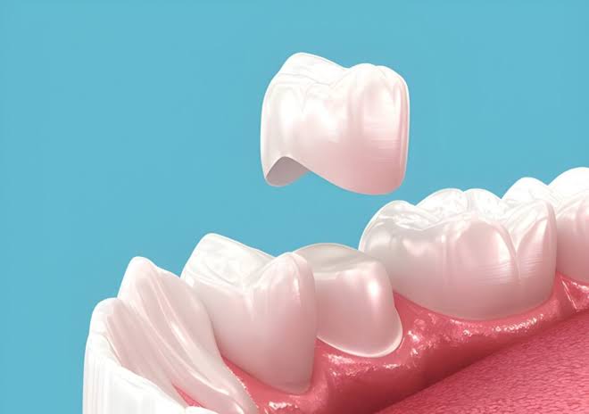dental bridges in flint