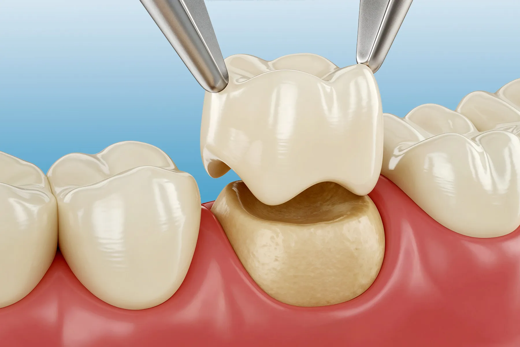 Zirconia crowns in flint