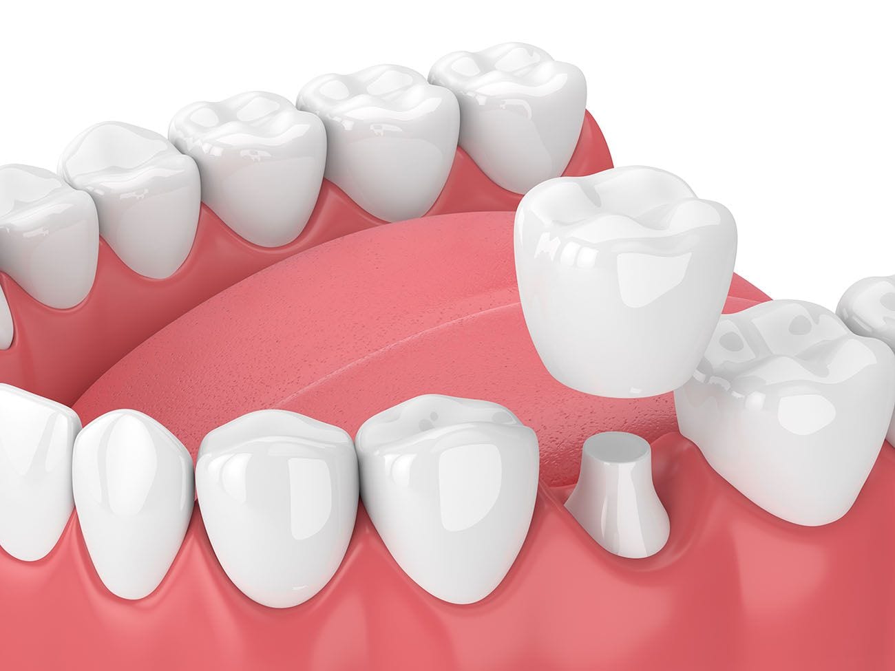 Zirconia crowns in flint