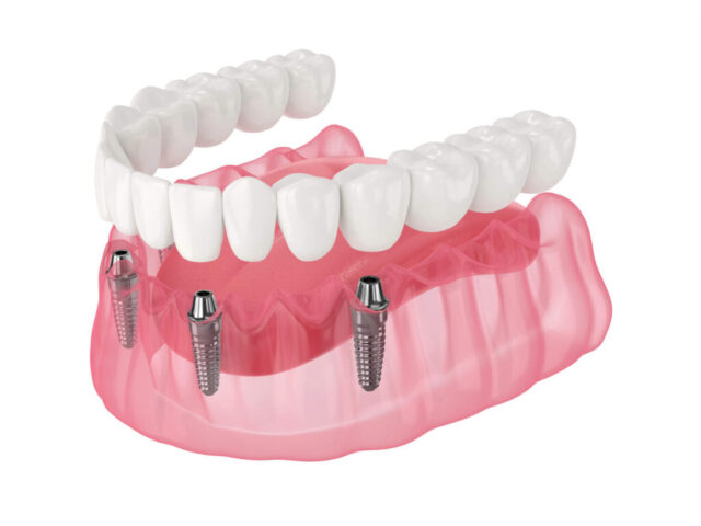 Implant Supported Dentures